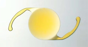 Intraocular Lens Implant